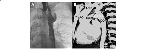 A Aortogram Showing Placement Of A Stent Across The Coarctation Of The Download Scientific