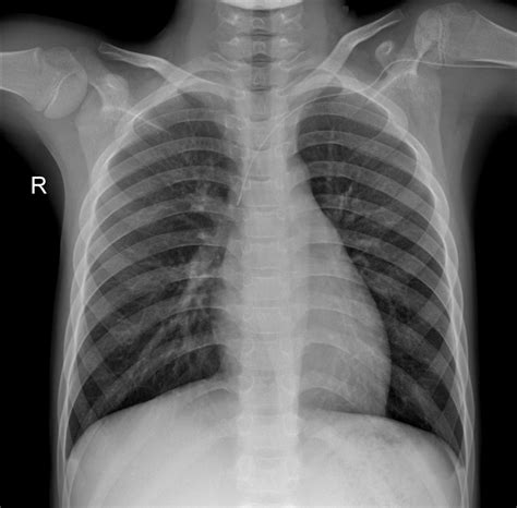 File Normal PA Chest X Ray Wikimedia Commons