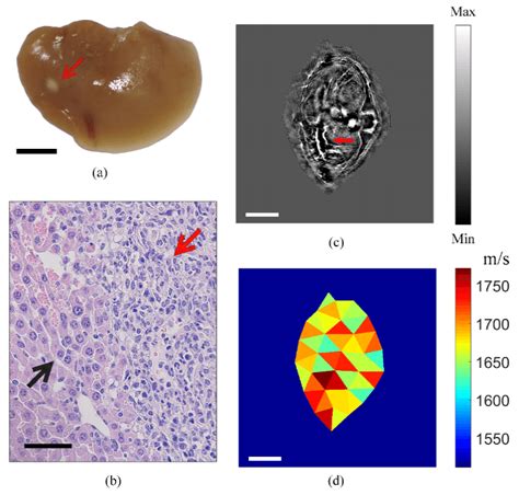 In Vivo PA Imaging Of An Orthotopic Mouse Model Of HepG2 A The