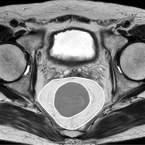 Mesorectal Fat Area And Circumference Of The Mesorectum And Rectum The