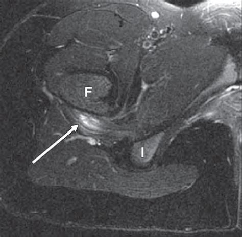 Year Old Girl With Right Hip Pain Axial Fat Suppressed T Weighted Mr