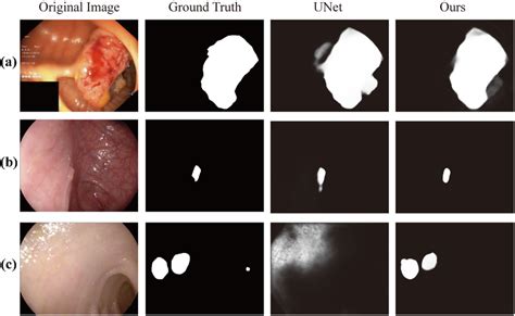 Examples Of Challenging Polyps In Colonoscopy Images And Their