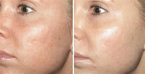 Microneedling San Antonio Tx Magnolia Medical And Aesthetics