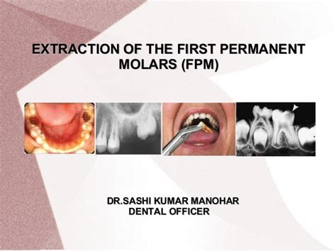 Extraction Of The First Permanent Molar