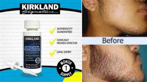 How to use Kirkland Minoxidil, Side Effects, Benefits & Reviews ...