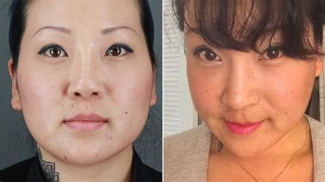 Asian Face Reconstructive Surgery Telegraph