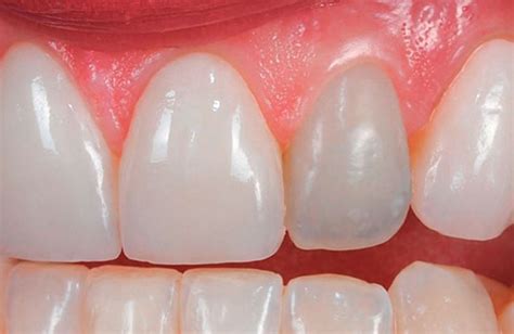 Dente Escuro Conhe A Principais Causas O Que Fazer E Como Tratar