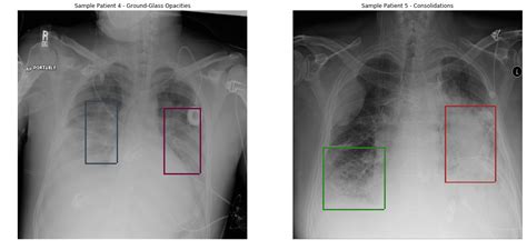 Pneumonia Detection From Chest Radiograph Cxr Intelec Ai Blog