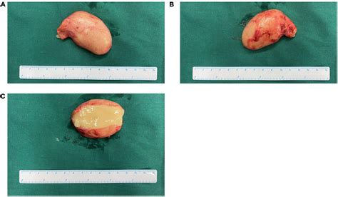 Frontiers Subdiaphragmatic Bronchogenic Cysts Case Series And