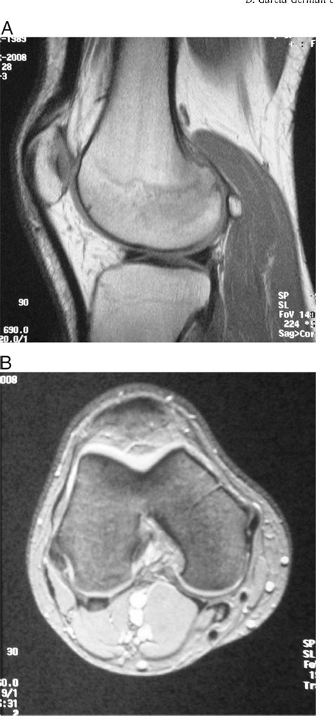 Figure 1 From Intra Articular Osteoid Osteoma Simulating A Painful