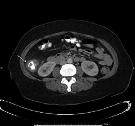 CT scan of abdomen with contrast with apple-core lesion in ascending ...