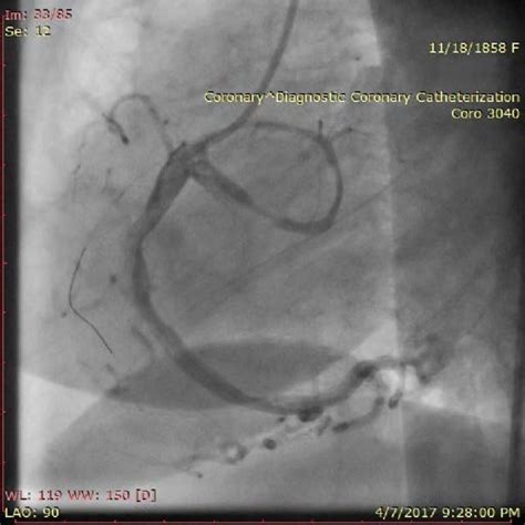 (PDF) Acute Thrombotic Coronary Occlusion in a Patient with Coronary ...