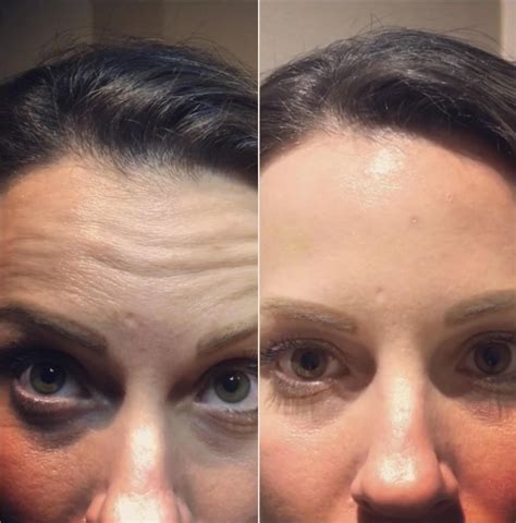 Botox Cosmetic Before And After Pictures Client Tampa Bay North