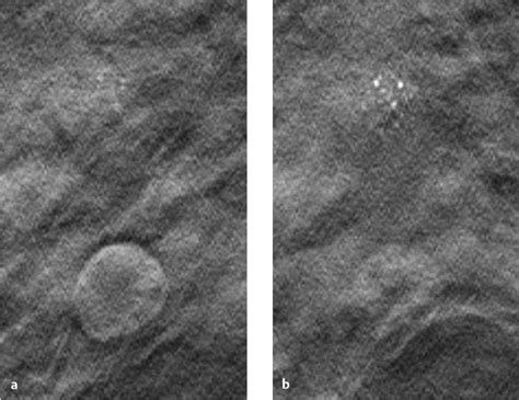 The Physics of Tomosynthesis | Radiology Key