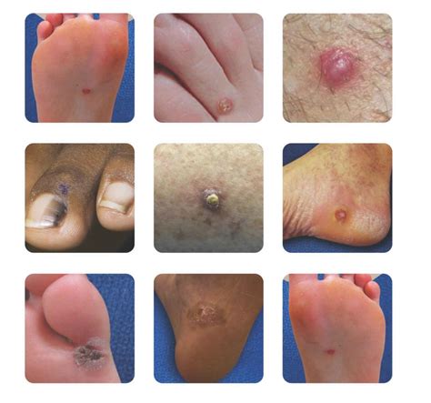 Pictures Of Skin Cancer On Heel Of Foot Best Sale