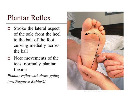 Babinski Reflex Interesting Medicine