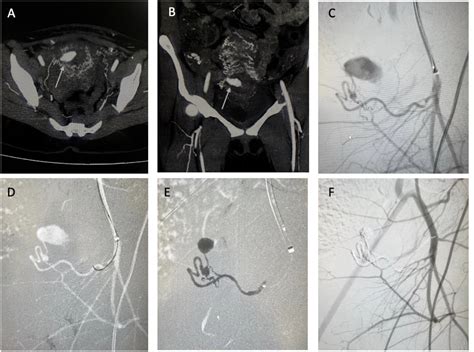 Figure From Transarterial Embolization Of Acquired Uterine Artery