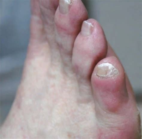 Thick Toenails Cause Symptoms And Treatment Blister Prevention