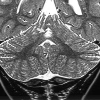 Coronal View T2 Weighted Fast Spin Echo 6480 96 MR Image Of A