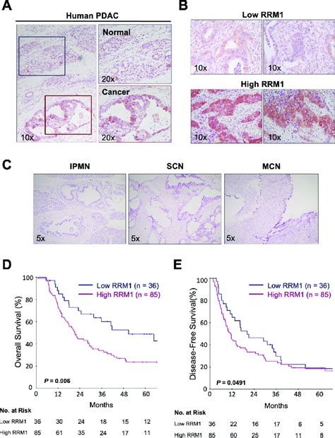 Association Between Rrm1 Expression And Prognosis In Pancreatic Cancer