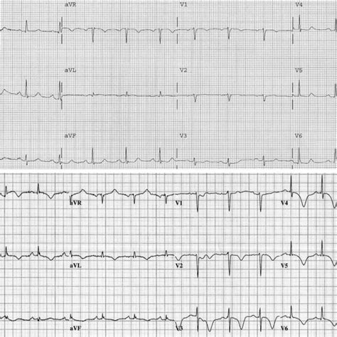 Top Baseline Electrocardiogram Ecg Taken Days Before Surgery The