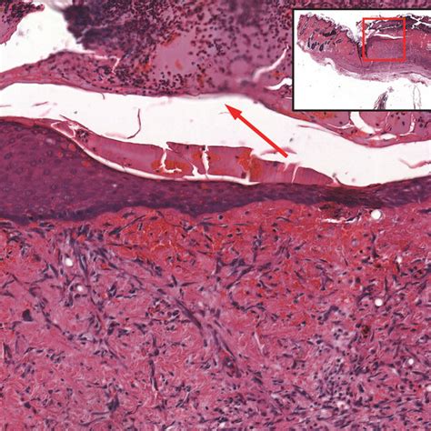 Representative Photomicrograph Of The Partially Re Epithelialized Skin Download Scientific