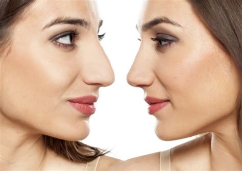 Botox Para Empinar O Nariz Dermaclinic Cotanet