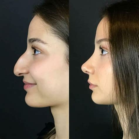 Dr Khaled Rabaya On Instagram Surgical Nose Job Transformation