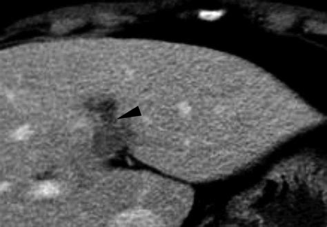 Relationship Between Various Patterns Of Transient Increased Hepatic