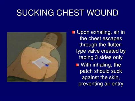 Ppt Chest Trauma Powerpoint Presentation Id 1438644