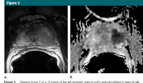 Diffusion Weighted Endorectal Mr Imaging At T For Prostate Cancer