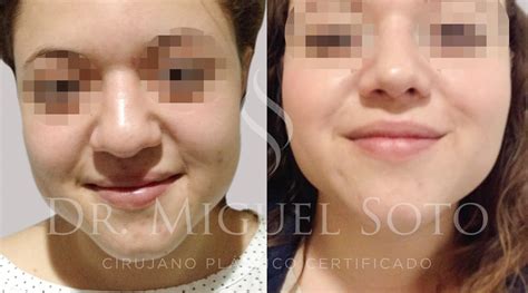 Rinoplastia Cdmx ️ Dr Miguel Soto