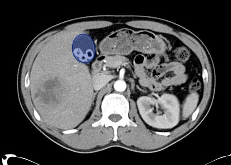 A Systematic Approach To The Interpretation Of Ct Abdomen Pelvis