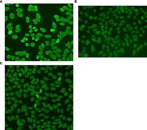 Frontiers Complex Patterns On Hep 2 Indirect Immunofluorescence Assay In A Large Sample