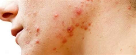 Nodulocystic Acne: Causes, symptoms, and treatments - The Kashmir Monitor