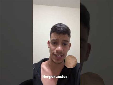 Diagn Stico Herpes Zoster Youtube