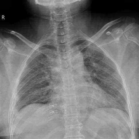 Posteroanterior Chest Radiography Revealing Rd Th Th And