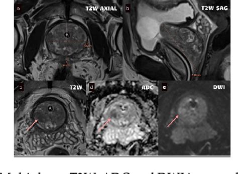 Figure From Role Of Multiparametric Magnetic Resonance Imaging In The