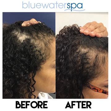 Hair Loss Because Of Stress Blue Water Spa PRF Injections Raleigh