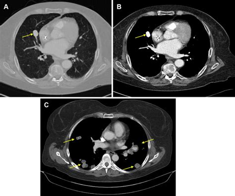 Pseudoaneurysms Can Be Seen Centrally And Peripherally A B Central