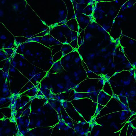 El Deterioro De Las Neuronas Es Fuente De Inflamación Del Cerebro