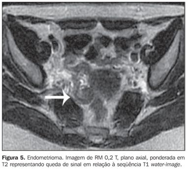 Scielo Brasil Endometriose P Lvica Compara O Entre Imagens Por