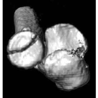 Dedicated Three Dimensional CT Reconstruction With The Distal Part Of