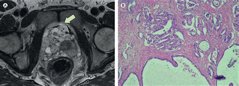 Mixed Acinar And Macrocystic Ductal Prostatic Adenocarcinoma The