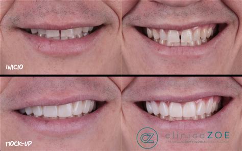 Dise O Digital De La Sonrisa Dsd Dentistas Zaragoza Cl Nica