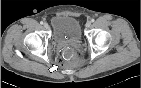 Presacral Abscess Arrow Secondary To Anastomotic Leakage Is Detected