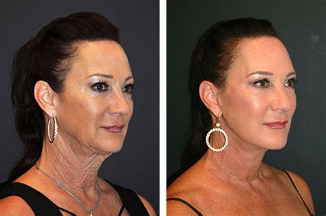 Deep Plane Facelift Deep Plane Facelifting Dr Andrew Jacono