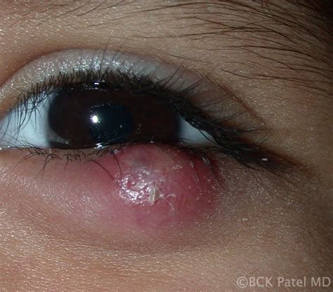 Chalazion Cyst Symptoms Pictures Causes And Treatment 55 Off