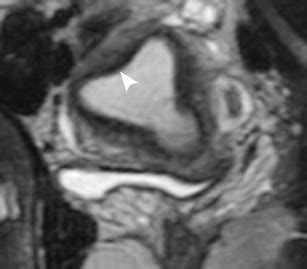 Arcuate uterus in an 11-year-old girl who presented with right lower... | Download Scientific ...