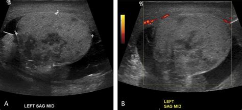 Testicular Infarct Gray Scale A And Power Doppler B Images Of The